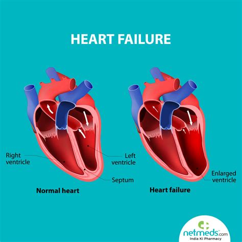 is lv dysfunction heart failure|what is moderate lv impairment.